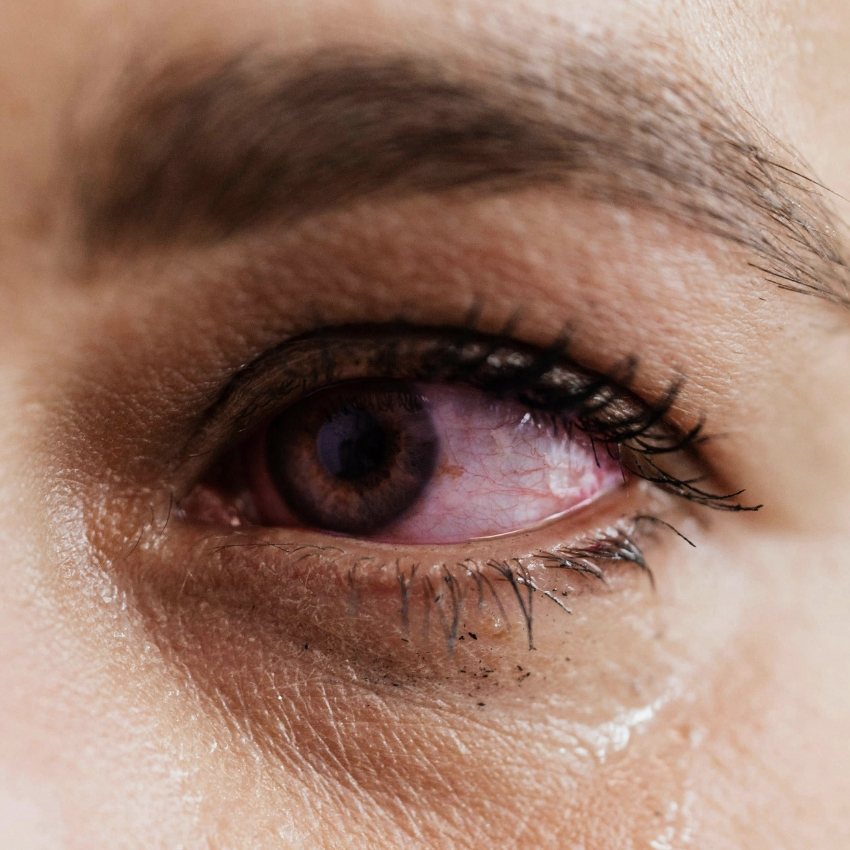 Close-up of a bloodshot eye with brown iris and dark eyelashes.